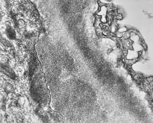 type III membranoproliferative glomerulonephritis type III membranoproliferative glomerulonephritis